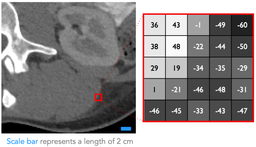 Subsection of an abodminal CT scan with a red square over an edge of an organ expanded out to a matrix to show the numerical values in that part of the image.